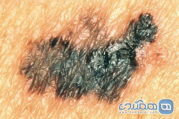 کدام خال ها نشانه سرطانند؟ کدام خال ها نشانه سرطانند؟